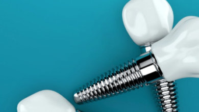 5 Benefits Of Choosing Implants Over Dentures Or Bridges