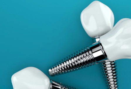 5 Benefits Of Choosing Implants Over Dentures Or Bridges