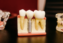 How Implant Dentistry Restores Both Aesthetics And Function