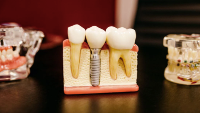 How Implant Dentistry Restores Both Aesthetics And Function