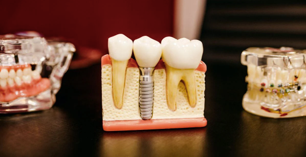 How Implant Dentistry Restores Both Aesthetics And Function